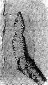 ������Ѫ˨