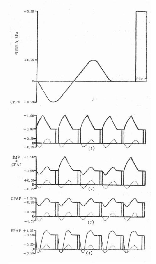 PEEP ���Ƶĸ��ֻ�еͨ������