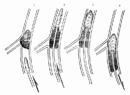 ����ȡ˨��ԭ��