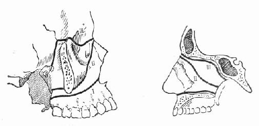 ���ǹ���LeFort���͵Ĳ����