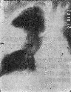 �Ρ�Ҷ��ʵ��֮X�߱���