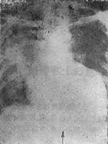 ���׸˾�������֮X�߱���