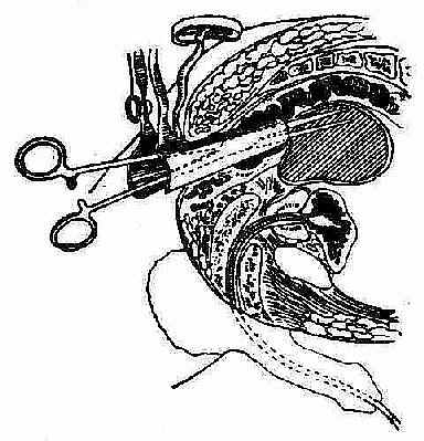 ���ŧҺ�󴩴��ݲ��γ����õ����ش��̷����п�����ֹѪǯ����ŧǻ�ſ�ֹѪǯ���������ڡ�