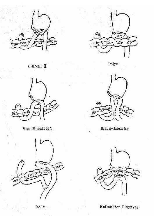 Billroth ��ʽθ�ճ��ǺϵĲ�ͬ����