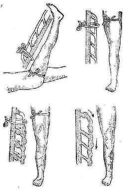 Trendelenburg����