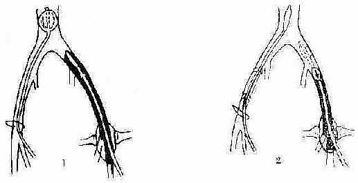 ����Ѫ˨ȡ����