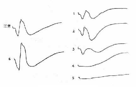 �����Ĳ�����ERG