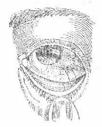 ����Ա��㹮Ĥ��