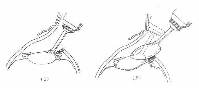 �䶳ժ����