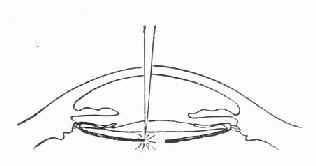 YAG��������г���